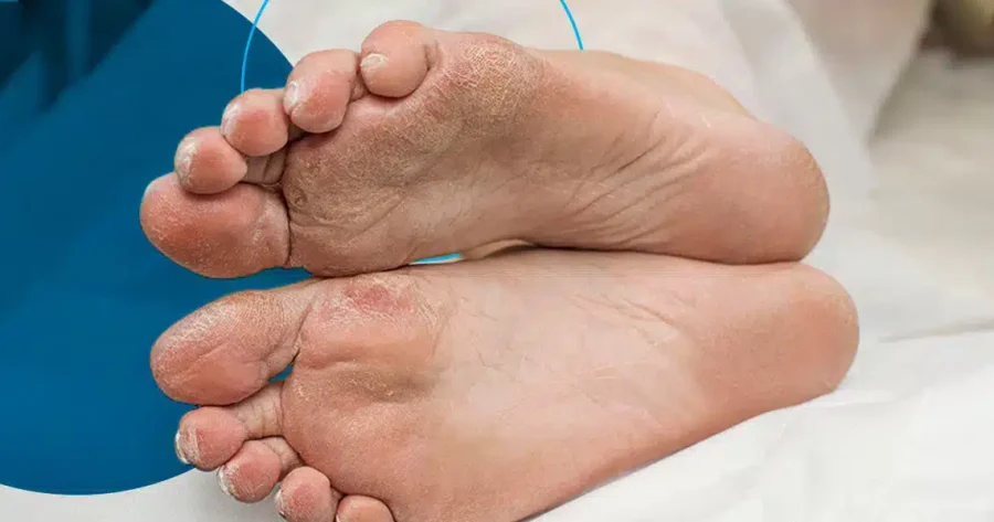 Προειδοποίηση: Αν το έχετε αυτό στα πόδια σας, μπορεί να είναι σημάδι