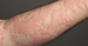 Γιατί εμφανίζονται εξανθήματα στο δέρμα; Αυτοί είναι οι εκπληκτικοί παράγοντες που μπορεί να μην γνωρίζετε.