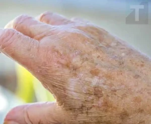 Γιατί εμφανίζονται κηλίδες στα χέρια μας και πώς μπορούμε να τις εξαλείψουμε;