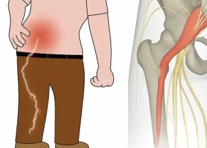3 ασκήσεις για την ανακούφιση από τον ισχιαλγικό πόνο στο πόδι: πρακτικές και αποτελεσματικές