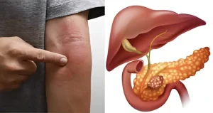 Το περίεργο σημάδι στο δέρμα που «δείχνει» καρκίνο στο πάγκρεας – Γρήγορα για εξετάσεις