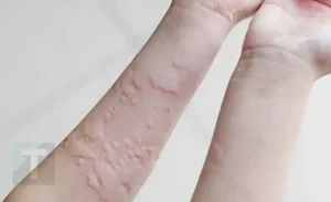 Αποκαλύφθηκαν oι αιτίες που προκαλούν την κνίδωση