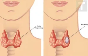 Οι περιπτώσεις καρκίνου του θυρεοειδούς αuξάνονται ραγδαία. Οι γιατροί συμβουλεύουν να τρώτε λιγότερο από αυτές τις τροφές