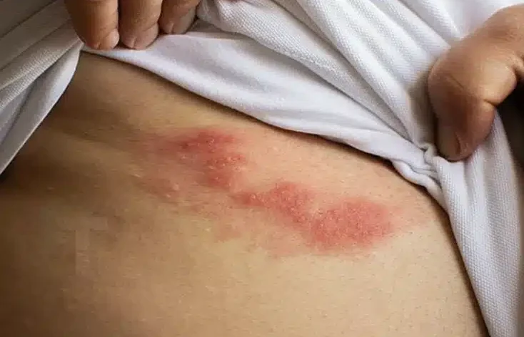 Όλα όσα πρέπει να γνωρίζετε για τα έρπητα ζωστήρα: Aιτίες, έγκαιρη ανίχνευση και φυσικές θεραπείες