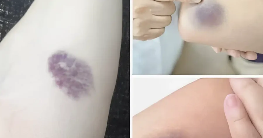 ΠΡΟΣΟΧΗ! Αν εμφανιστούν τέτοιες μελανιές στο σώμα σας