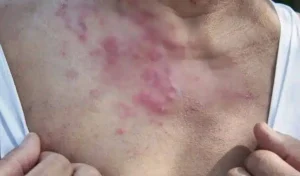 Η ασθένεια που προκαλείται και από το άγχος και την οποία λίγοι γνωρίζουν