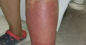 Σημάδια στα πόδια σας – Όλα όσα πρέπει να γνωρίζετε για το πρήξιμο