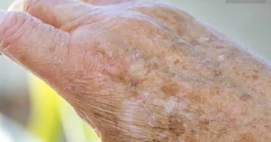 Αδιανόητο, γνωρίζατε ότι αν εμφανιστούν κηλίδες στα χέρια σας, είναι ξεκάθαρο σημάδι ότι…