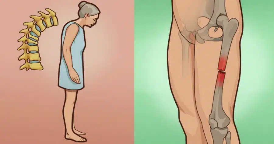 Οστεοπόρωση: Το ελληνικό βότανο που δυναμώνει και προστατεύει τα κόκκαλα