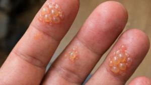 Τα δάχτυλα του συζύγου είναι καλυμμένα με αυτές τις μικροσκοπικές φουσκάλες νερού. Δεν μπορεί καν να πληκτρολογήσει για τη δουλειά