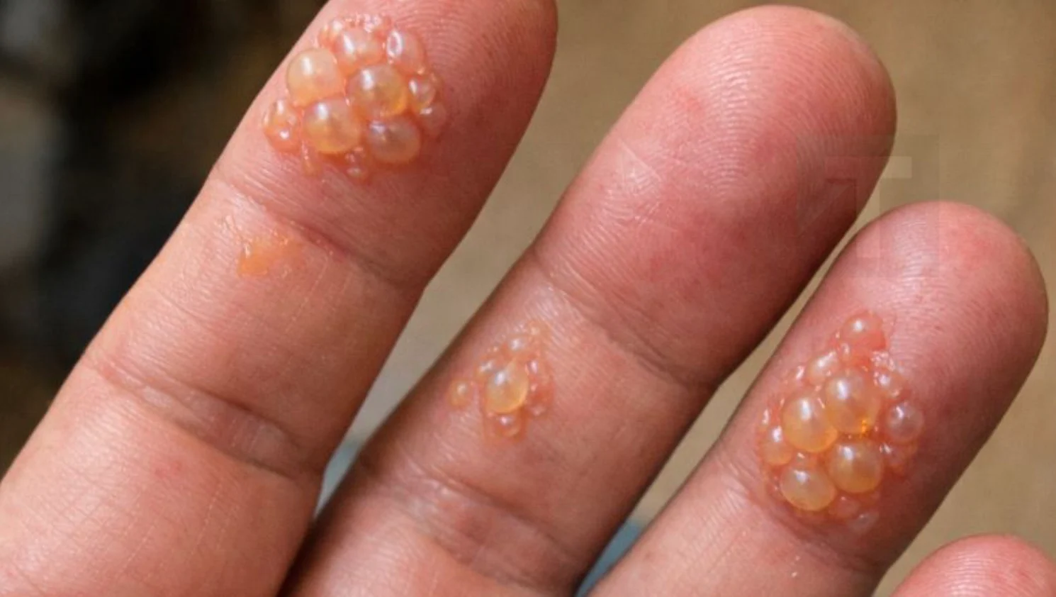 Τα δάχτυλα του συζύγου είναι καλυμμένα με αυτές τις μικροσκοπικές φουσκάλες νερού. Δεν μπορεί καν να πληκτρολογήσει για τη δουλειά