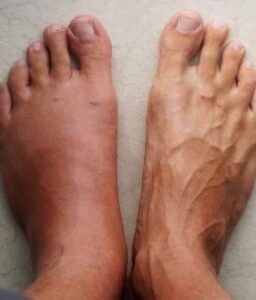 7 σημάδια που μπορεί να προειδοποιούν για καρδιακή προσβολή