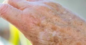 Αν εμφανιστούν κηλίδες στα χέρια μας, Auτά πρέπει να ξέρετε