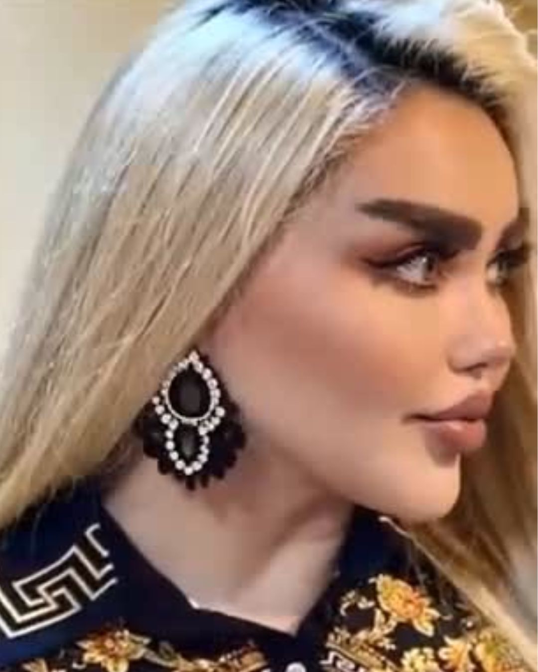 Οι 43 χειρουργικές επεμβάσεις που έκανε για να μοιάζει με κούκλα, προκαλούν θύελλα αντιδράσεων