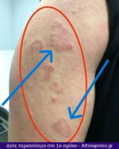 Είναι μεταδοτικά τα κόκκινα κυκλικά εξανθήματα στο μπράτσο; Όλα όσα πρέπει να γνωρίζετε