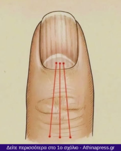 Τι να τρώτε για να μειώσετε τις ραβδώσεις στα νύχια: Διατροφικός οδηγός για υγιέστερα νύχια