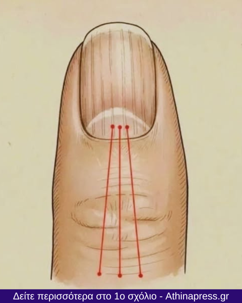 Τι να τρώτε για να μειώσετε τις ραβδώσεις στα νύχια: Διατροφικός οδηγός για υγιέστερα νύχια