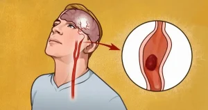 Όποιος κάνει αυτά τα 4 πράγματα μειώνει κατά 80% την πιθανότητα για εγκεφαλικό: Θυμηθείτε τα αρχικά ΑΠΧΚ!