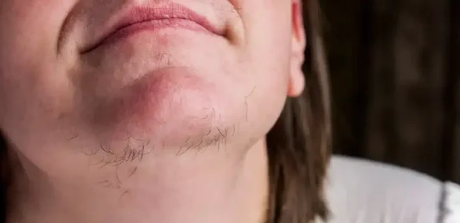 Αν είστε γυναίκα με γένια στο σαγόνι να τι σημαίνει για εσάς – Αυτές οι τρίχες στο…