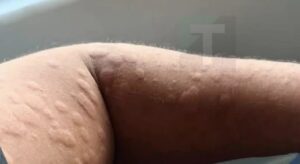 Τι είναι, πώς εμφανίζεται και πότε χρειάζεται ιατρική επίβλεψη