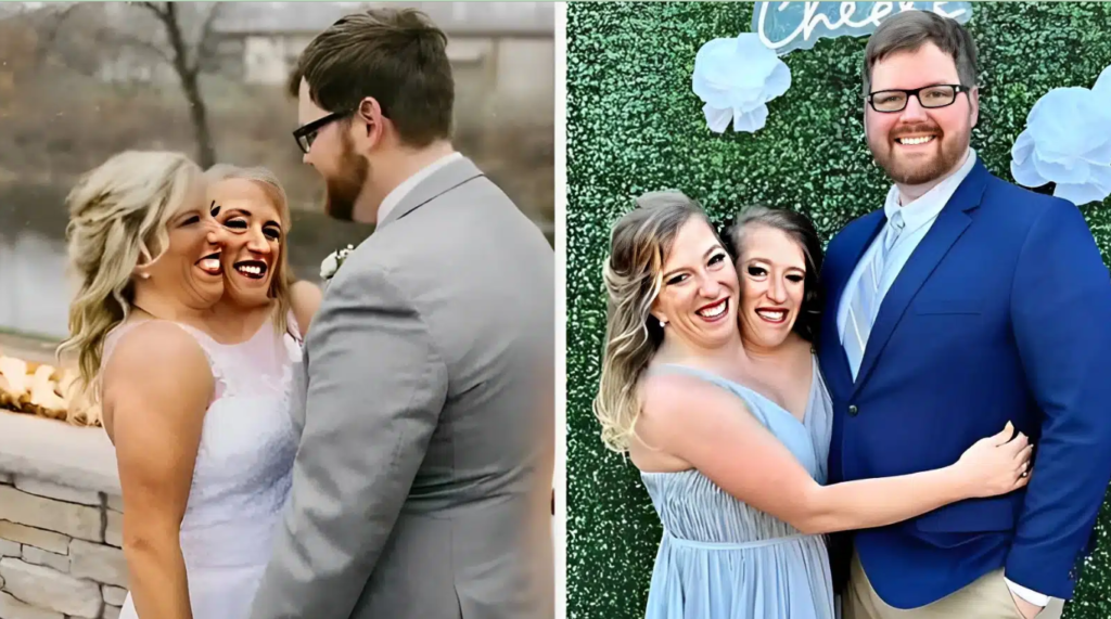 Σιαμαίες δίδυμες που παντρεύτηκαν τον ίδιο άντρα έδειξαν φωτογραφίες με τον σύζυγό τους και την κόρη τους