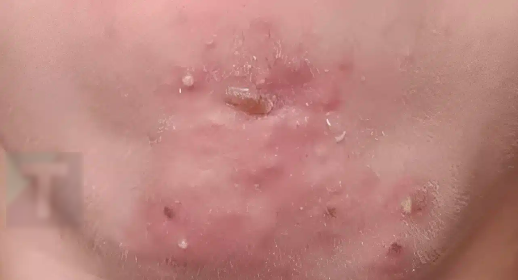 Έβγαινα με μια γυναίκα που γνώρισα στο σουπερμάρκετ και αφού τελικά πήγα μαζί της ξύπνησα με αυτά στο πρόσωπό μου. Τι είναι αυτό;