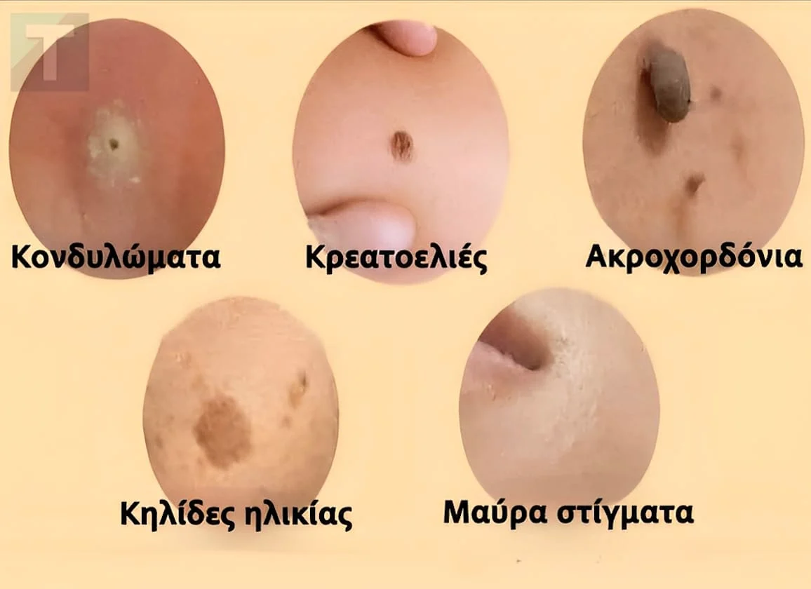 Αντιμετωπίστε φυσικά κηλίδες, κρεατοελιές, μυρμηγκιές και μαύρα στίγματα