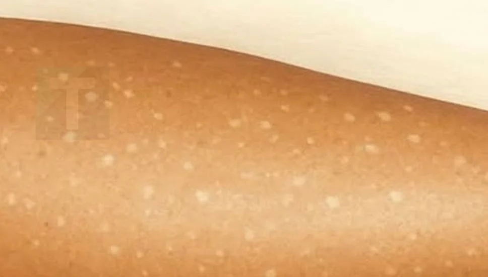 Λευκές κηλίδες στο δέρμα: Ποιες ελλείψεις βιταμινών μπορεί να είναι η αιτία;