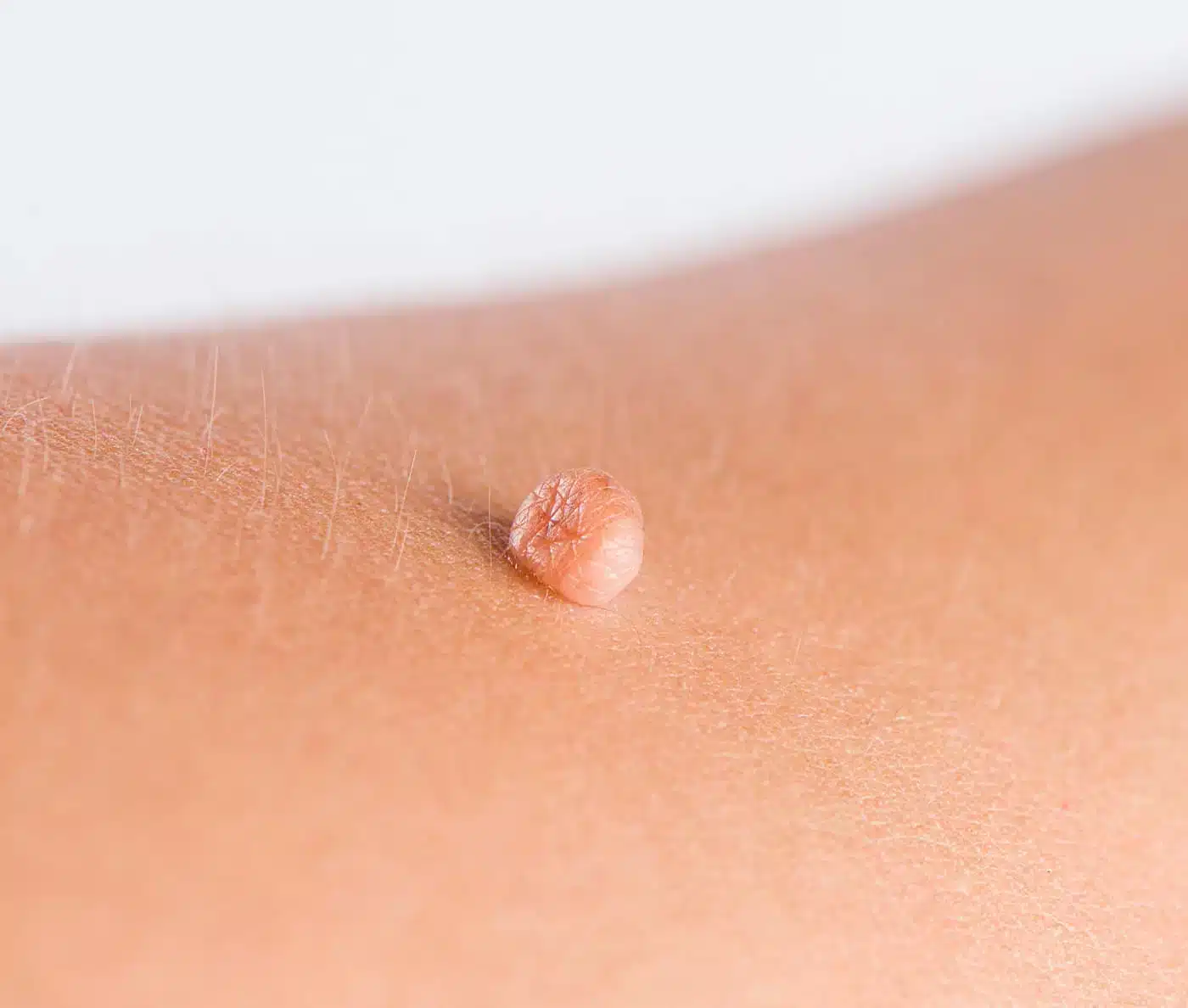 traitement excroissance peau skin marceau paris.jpg