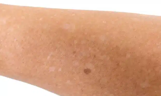 white spots hand skin 666x399 1