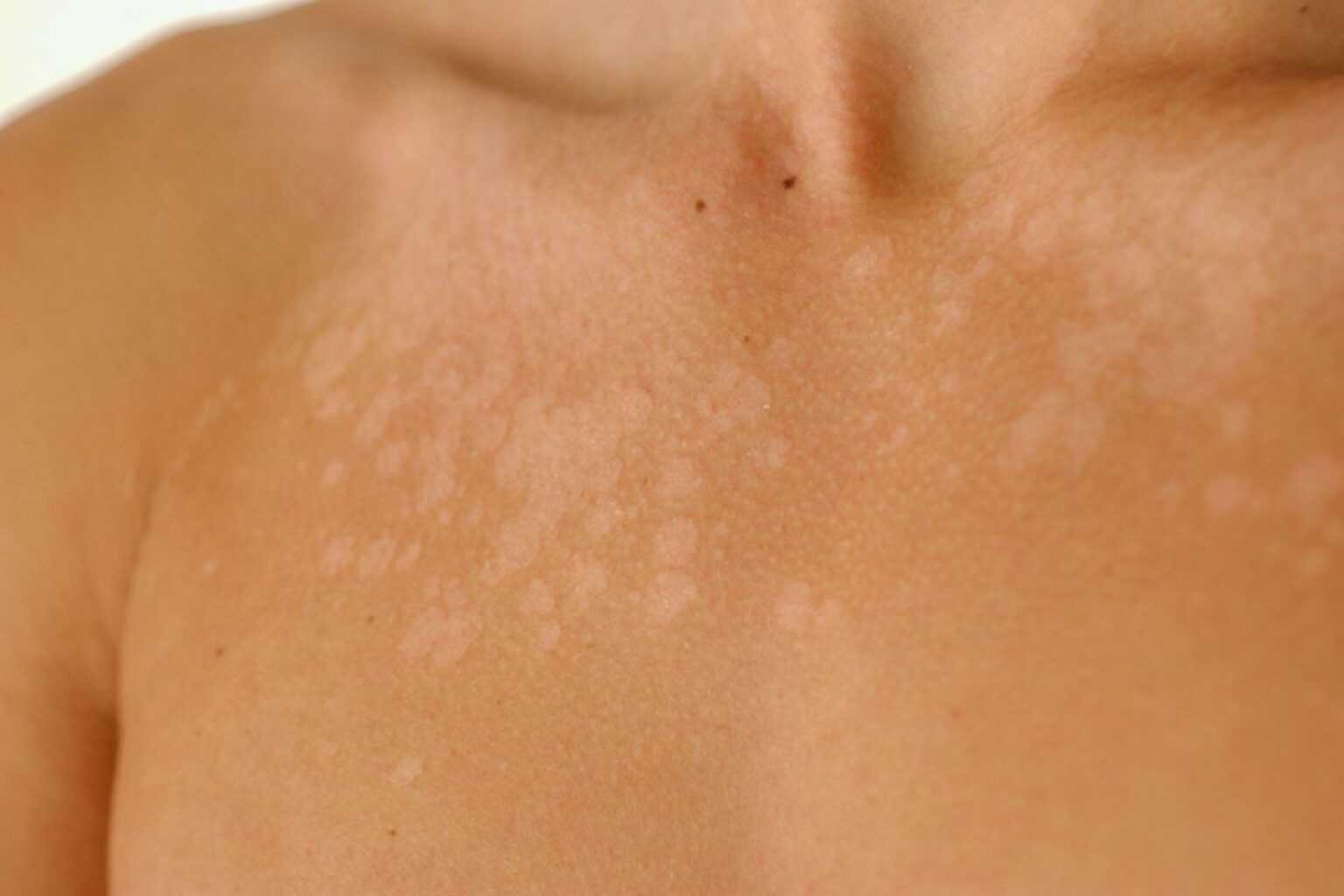 ypomelagch f3.large1 1536x1024 1