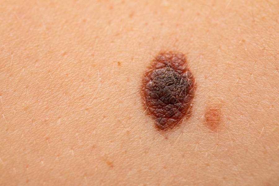 melanoma