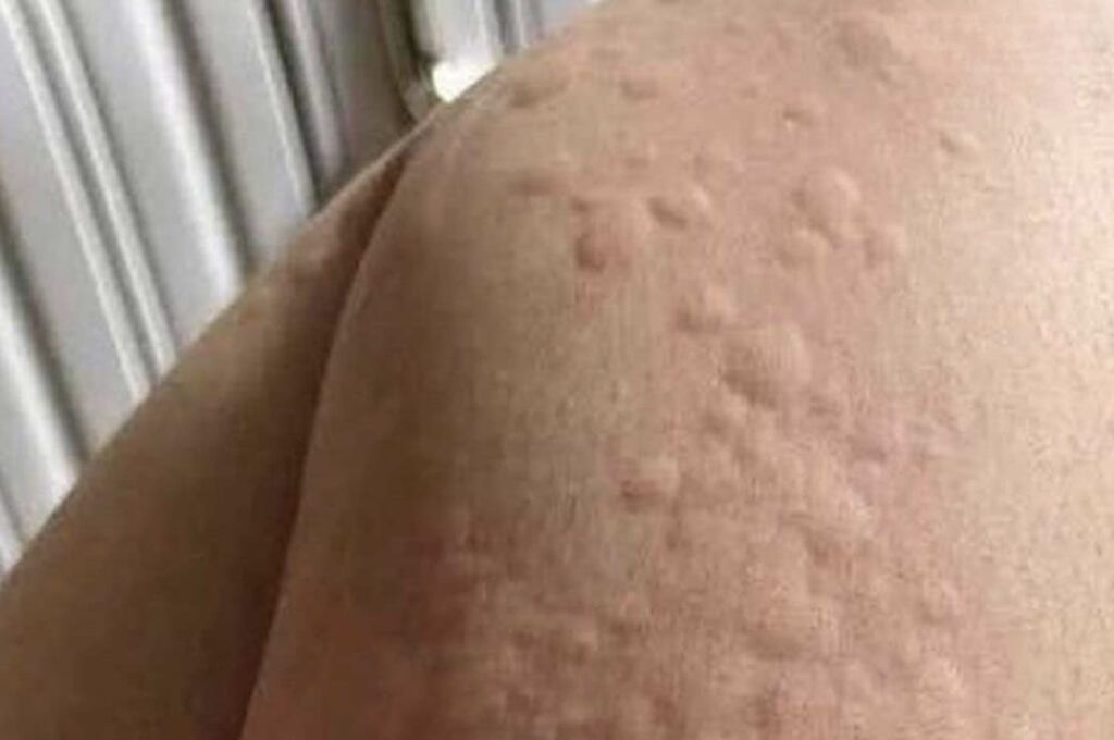 Να είστε προσεκτικοί αν σας τρώει το σώμα και εμφανιστούν αυτά τα εξογκώματα στο δέρμα σας…
