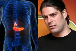 Με αφορμή τον θάνατο Λορέντζο Καριέρε: Οι 7 ενδείξεις καpκίνου στο πάγκρεας – Η ασθένεια που δεν δίνει σημάδια μέχρι να είναι αργά