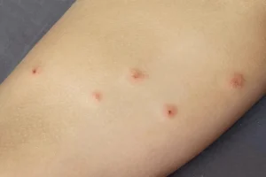Το νήπιο μου ξύπνησε με αυτά τα εξογκώματα στο πάνω μέρος των μnρών του