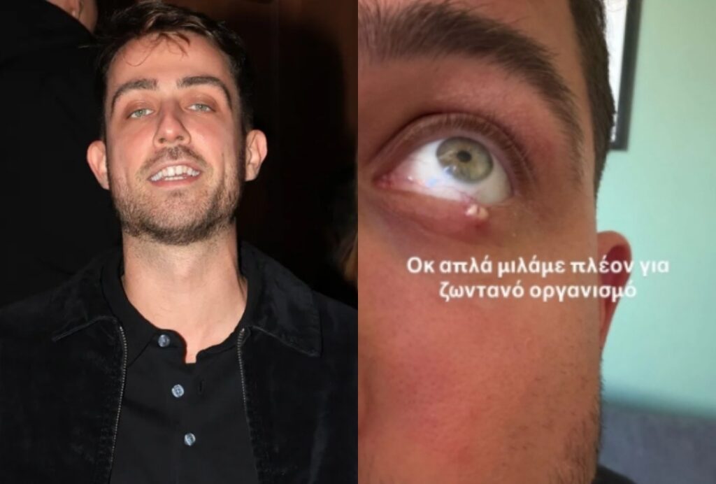 Με αφορμή τον Fipster: Τι είναι το χαλάζιο που τον ταλαιπωρεί – Από τι προκαλείται και πώς αντιμετωπίζεται