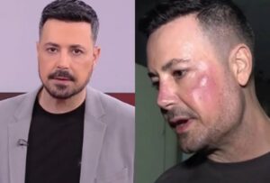 Με αφορμή τον Πέτρο Κουσουλό: Τι είναι η γυροειδής αλωπεκία που τον ταλαιπωρεί – Τα σημάδια που δεν πρέπει να αγνοήσεις