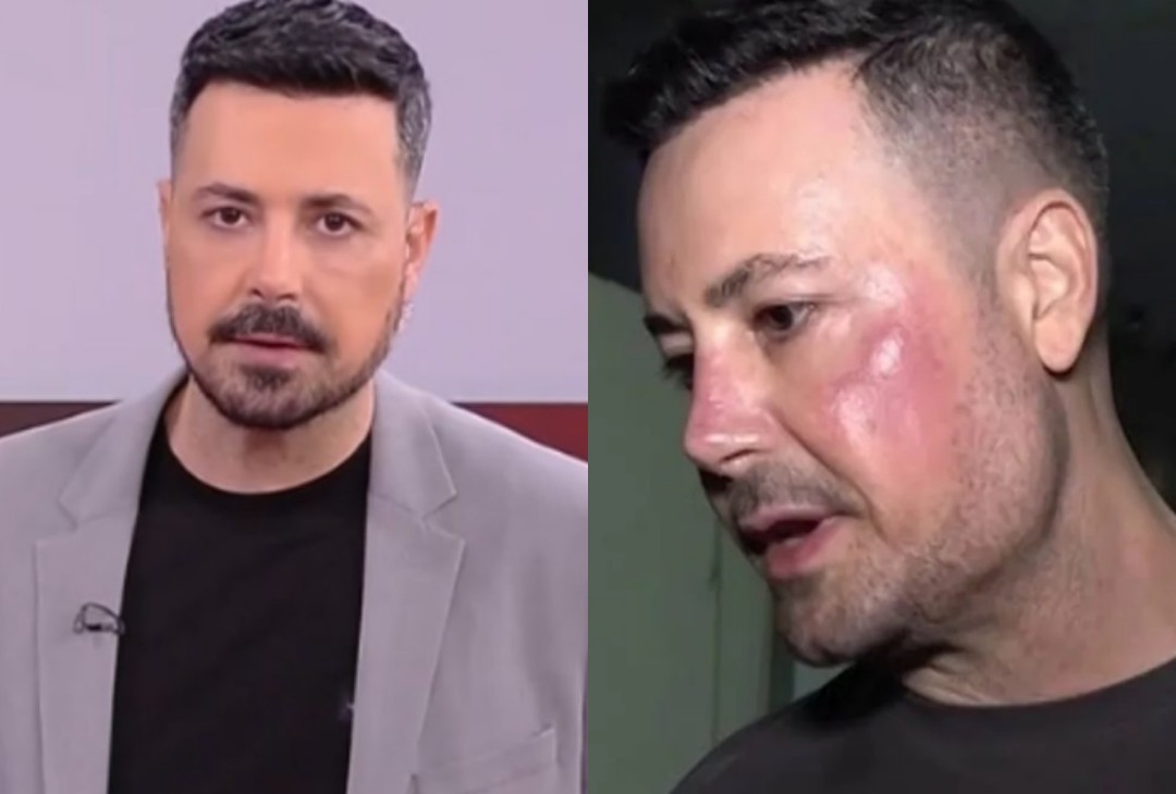 Με αφορμή τον Πέτρο Κουσουλό: Τι είναι η γυροειδής αλωπεκία που τον ταλαιπωρεί – Τα σημάδια που δεν πρέπει να αγνοήσεις